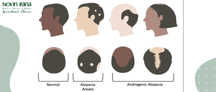 خطوات زراعة الشعر الطبيعي