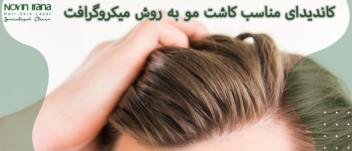 کاندیدای مناسب کاشت مو به روش میکروگرافت