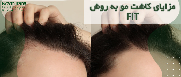 مزایای کاشت مو به روش FIT