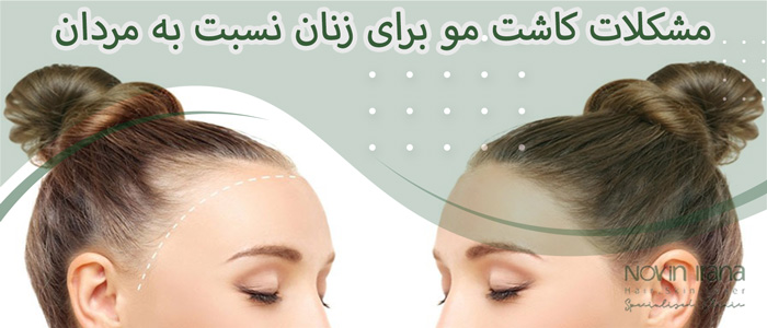 مشکلات کاشت مو برای زنان نسبت به مردان