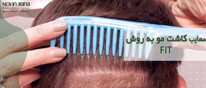 معایب کاشت مو FIT