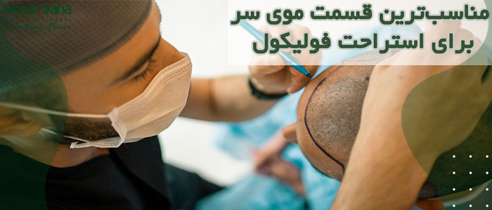 كاشت مو سر FIT