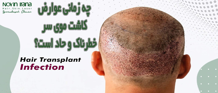 چه زمانی عوارض کاشت موی سر خطرناک است