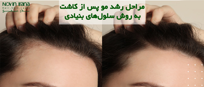 روش سلول بنیادی برای مو