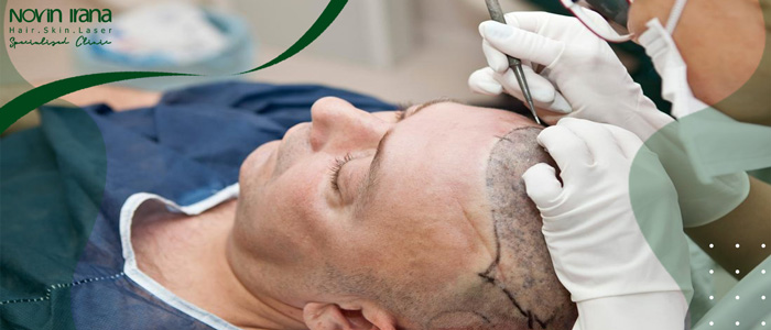 تفاوت bht با سایر روش های کاشت مو
