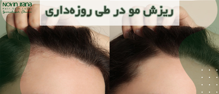 ریزش مو در طی روزه داری