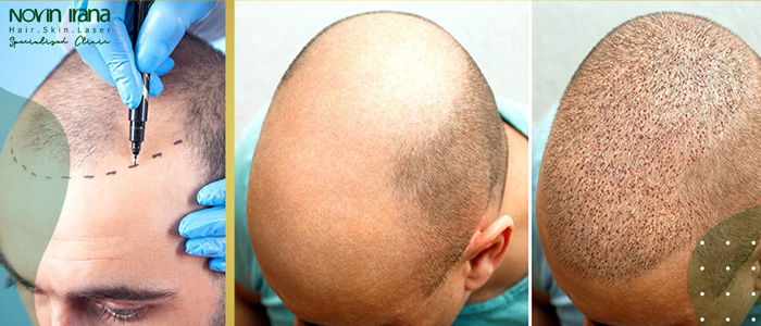 مزایای کاشت مو به روش super fue