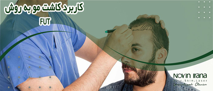 کاشت مو fut