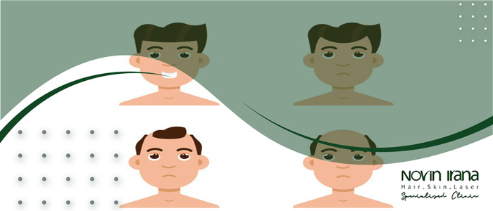 کاشت مو به روش super fue چیست