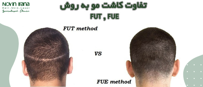 تفاوت کاشت مو به روش fue , fut