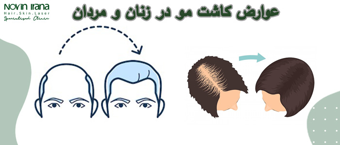 عوارض کاشت مو برای زنان و مردان