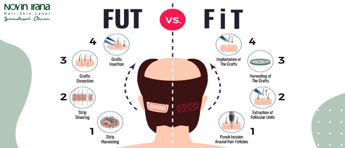 تفاوت کاشت مو به روش fut , fit