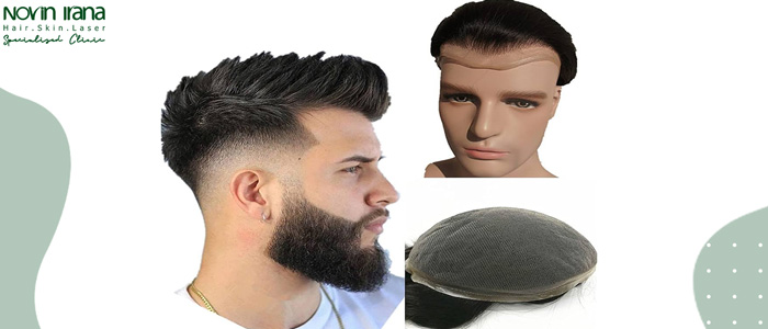 انواع پروتز مو