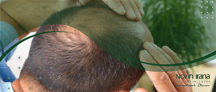 مراقبت های قبل و بعد از کاشت مو به روش super fue