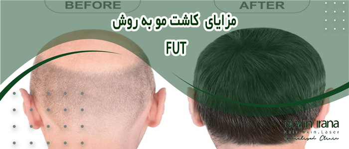 هزینه کاشت مو fut