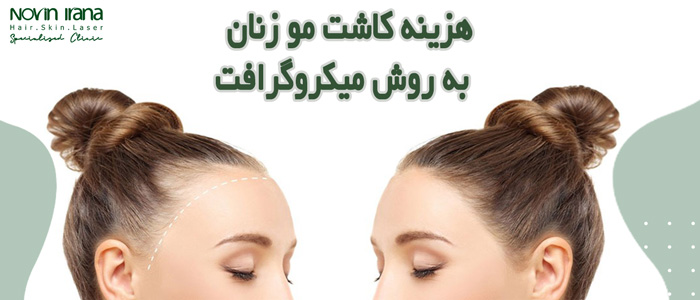 هزینه کاشت مو زنان به روش میکروگرافت