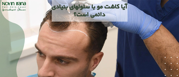آیا کاشت مو با سلولهای بنیادی دائمی است؟
