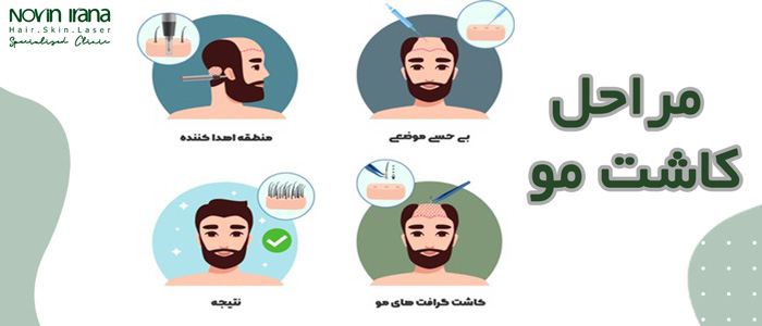 مراحل کاشت مو