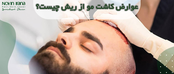 عوارض کاشت مو از ریش