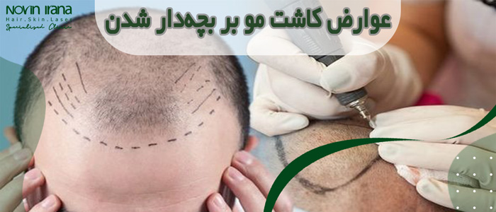 عوارض کاشت مو بر بچه دار شدن