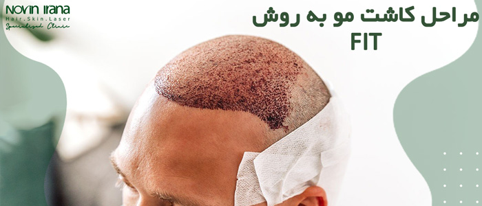مراحل کاشت مو به روش fit