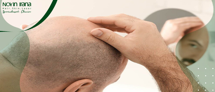 أنواع طرق زراعة الشعر