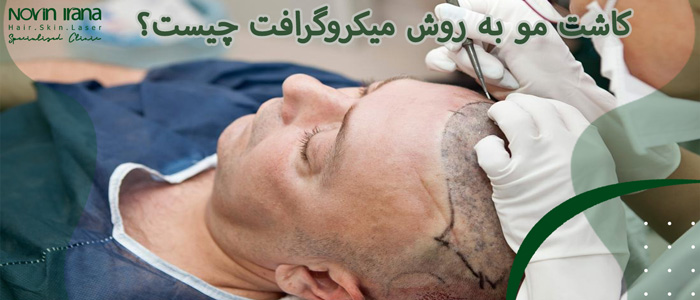 کاشت مو به روش میکروگرافت چیست