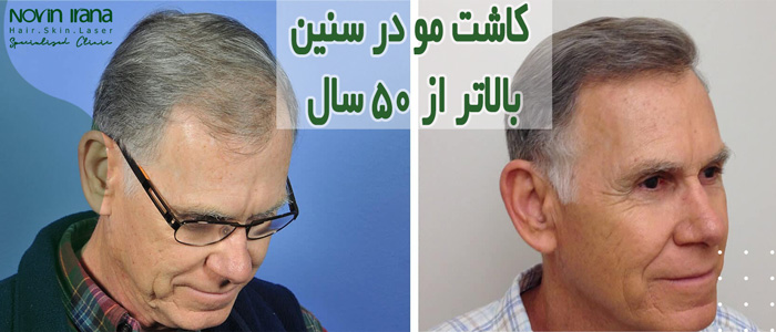 كاشت مو ىر سن بالاتر اؤ 50 سال
