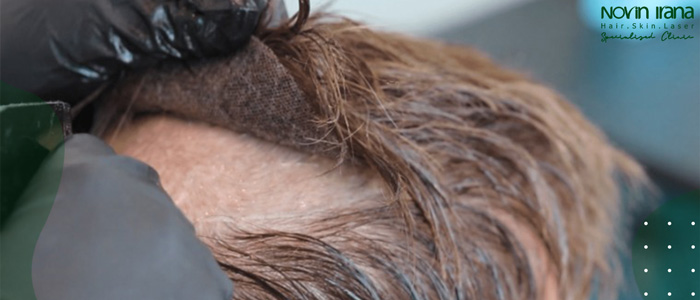 آیا پروتز مو دائمی است