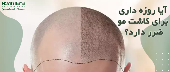 آیا روزه داری برای کاشت مو ضرر دارد