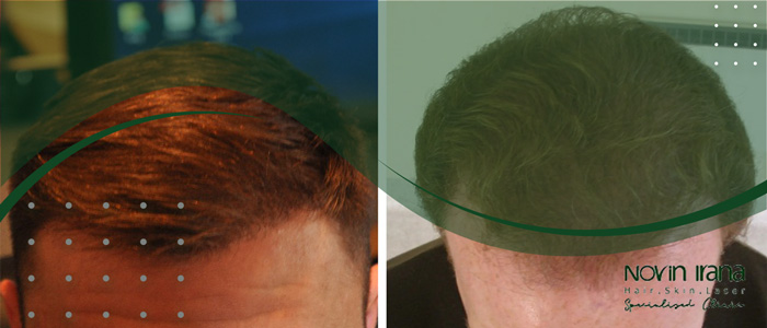 مميزات زراعة الشعر fue و fut