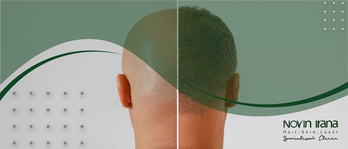 التحضيرات قبل زراعة الشعر بطريقة FIT