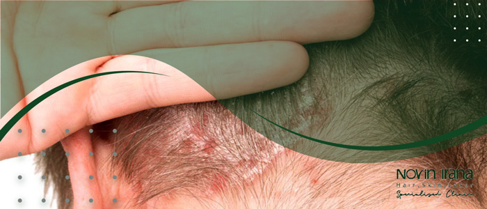 مراحل قبل از زراعة الشعر لمرضى الصدفية