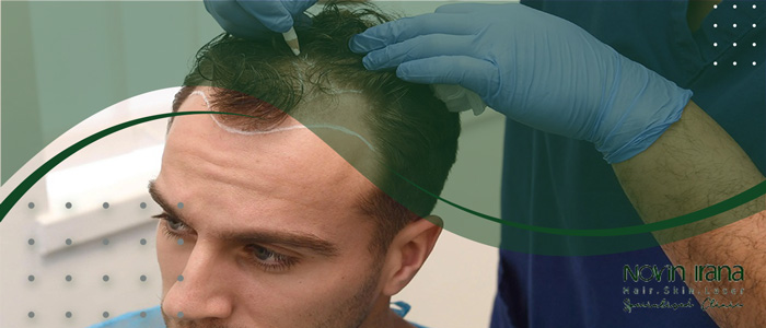ما هي العوامل التي تحدد مدة زراعة الشعر