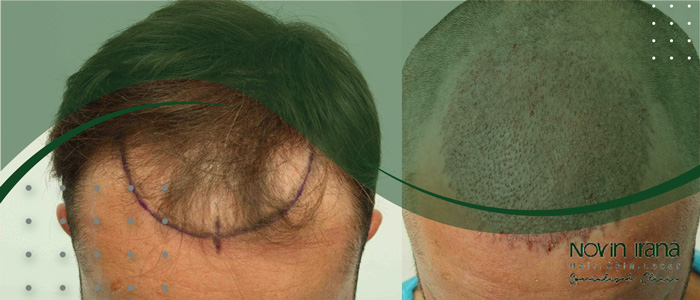 أي طرق زراعة الشعر تحتاج إلى أقل وقت
