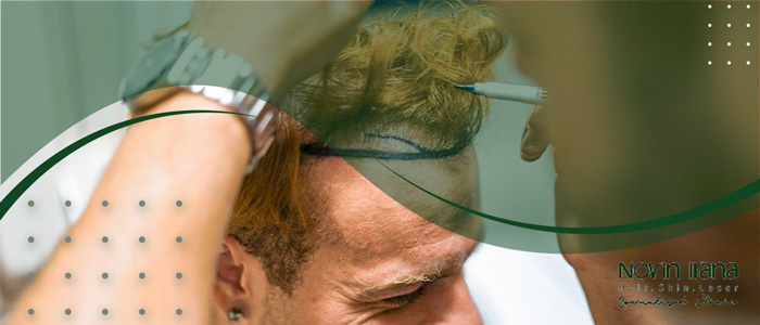 السن المناسب لزراعة الشعر للرجال