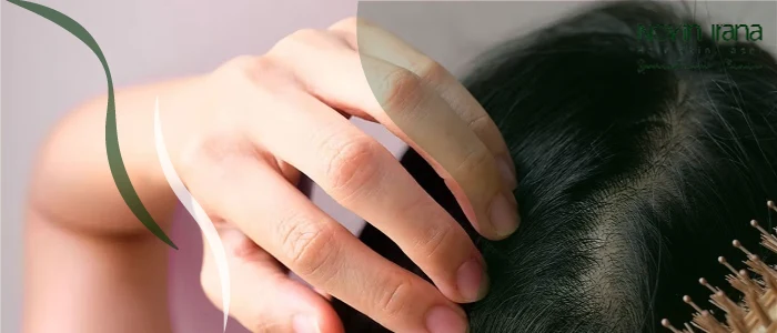 تاثیر اسپیرونولاکتون بر ریزش مو
