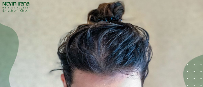 هل يؤثر ضرب الرأس على مستوى زيت الشعر بعد عملية زراعة الشعر المتحرك