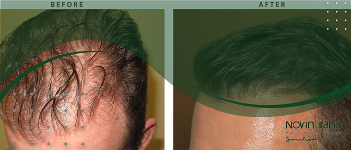 افضل عمر لزراعة الشعر