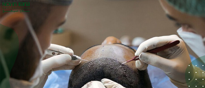 الشروط اللازمة لزراعة الشعر