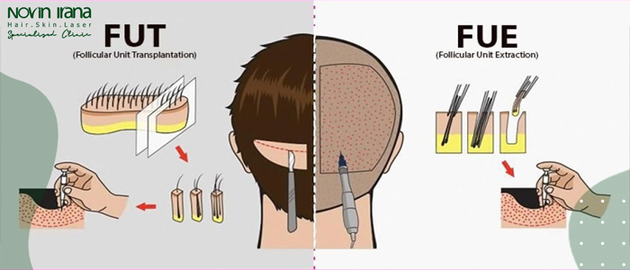 مراحل إجراء زراعة الشعر بطريقة FUT