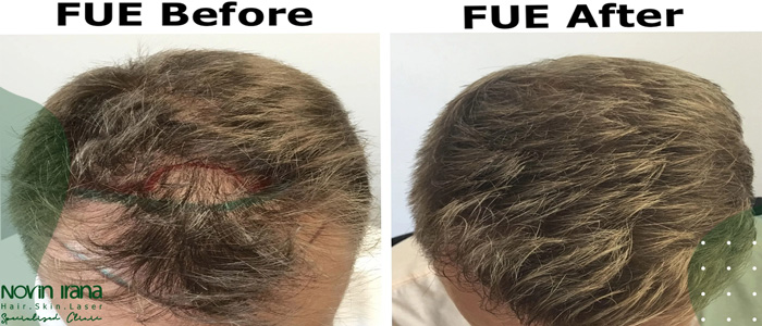 مزايا زراعة الشعر بطريقة FUT