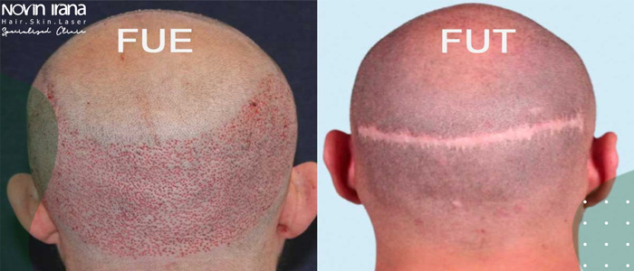 مراحل إجراء زراعة الشعر بطريقة FUE