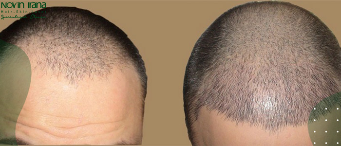 العناية بعد زراعة الشعر بطريقة FIT