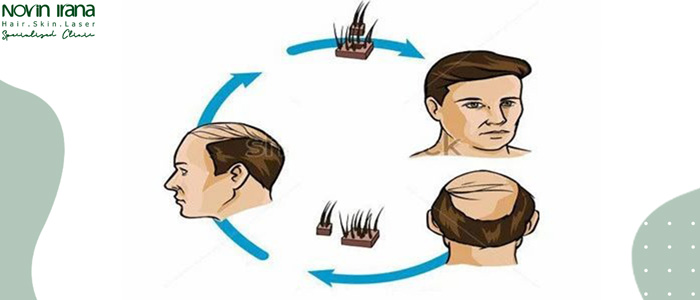 من هم الأشخاص المناسبين لزراعة الشعر بتقنية FIT
