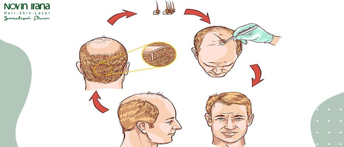 آثار زراعة الشعر في العمر المناسب