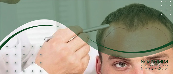 زراعة الشعر بطريقة FUE  و FUT