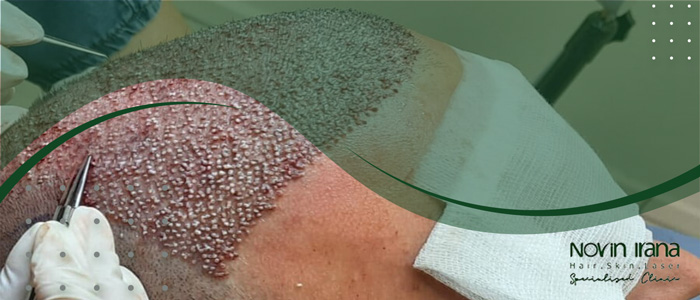 زراعة الشعر في العمر المناسب