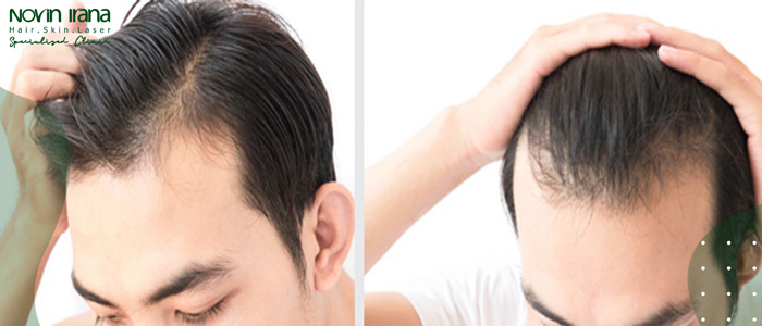 متى تفشل عملية زراعة الشعر