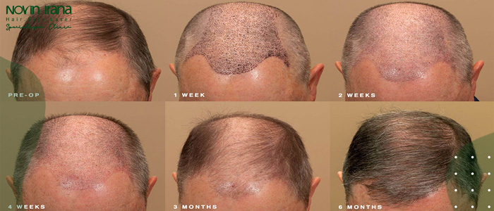 ما هی العناية بعد زراعة الشعر؟